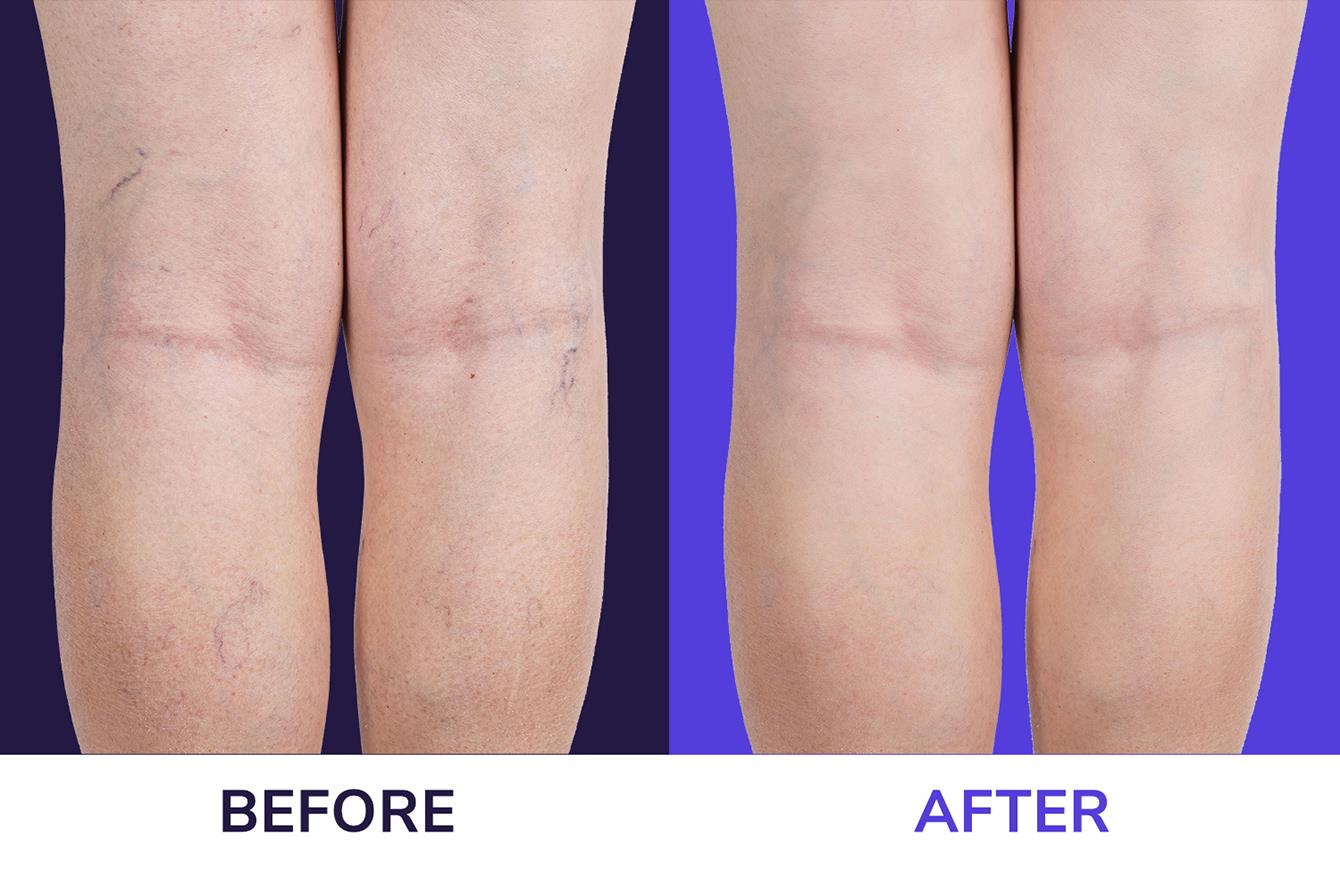 How to Prevent Varicose Veins Before They Start
